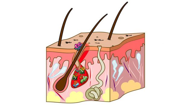 Skin cross section showing the causes of acne.
